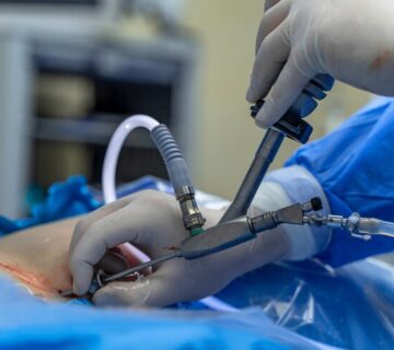 Surgery surgeon is operating with special equipment doctor s hands closeup modern medical background 116317 4880 360x320