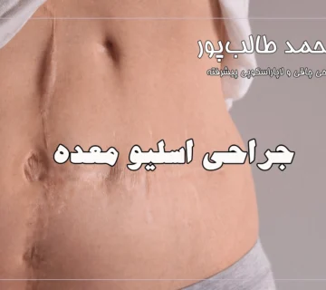 جراحی اسلیو معده