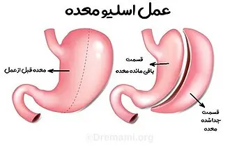 اتاق عمل جراحی لاپاراسکوپی چاقی مفرط