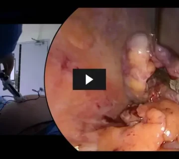 Laparoscopic surgery video for primary appendicitis with diagnostic evaluation of the ovaries in a young woman 360x320