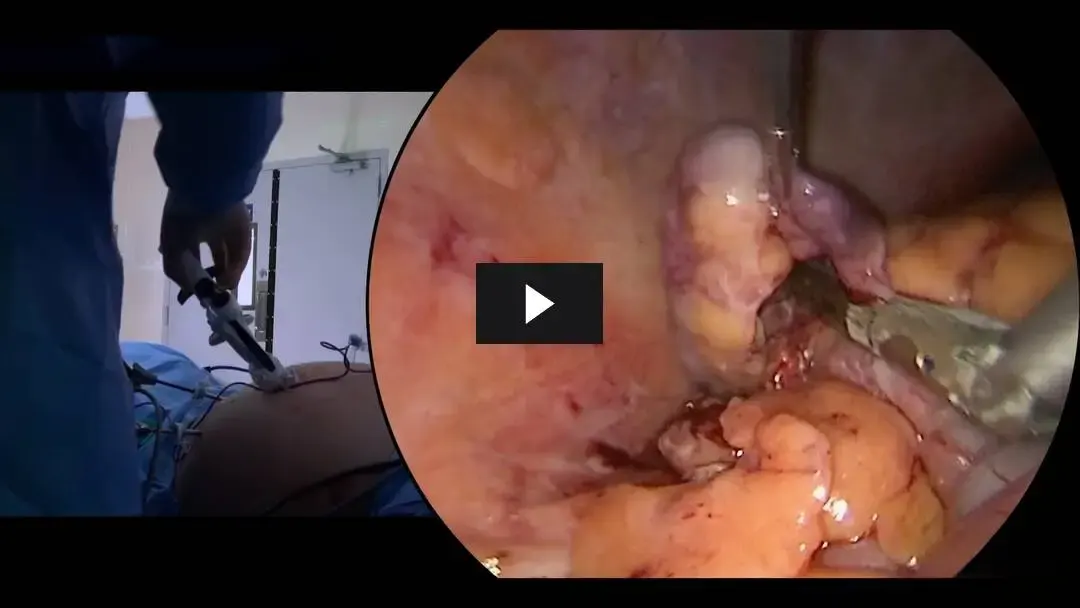 Laparoscopic surgery video for primary appendicitis with diagnostic evaluation of the ovaries in a young woman