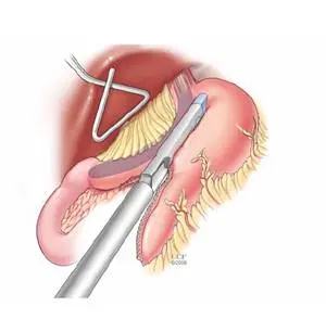 انجام عمل اسلیو معده در اتاق عمل توسط جراح متخصص