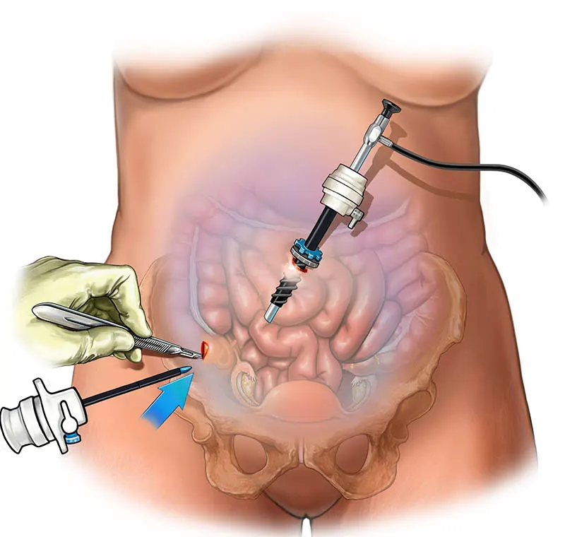 Laparoscopic surgery video for primary appendicitis with diagnostic evaluation of the ovaries in a young woman