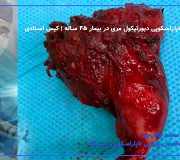 گزارش جراحی لاپاراسکوپی دیورتیکول مری در بیمار ۴۵ ساله