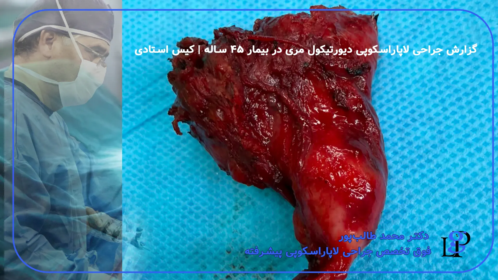 گزارش جراحی لاپاراسکوپی دیورتیکول مری در بیمار ۴۵ ساله
