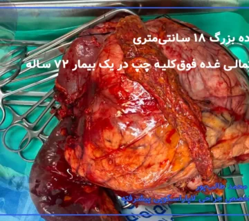 توده بزرگ غده فوق کلیه