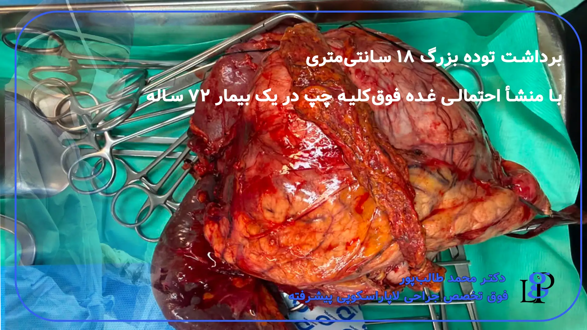توده بزرگ غده فوق کلیه