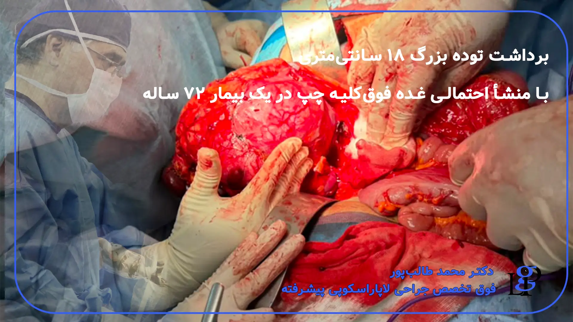 توده بزرگ غده فوق کلیه